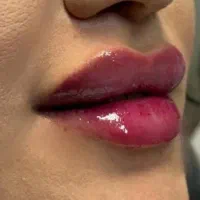 جشنواره خدمات ژل فقط 550و بوتاکس750