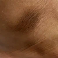 درمان تیرگی های بدن|آرایشی، بهداشتی، درمانی|مشهد, چهارچشمه|دیوار