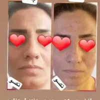 پوستی صاف وشفاف|آرایشی، بهداشتی، درمانی|قم, صفائیه|دیوار