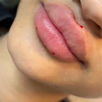 لب روسی زاویه سازی فول فیس لیفت ژل صورت بوتاکس مزو