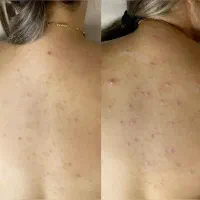 درمان جوش صورت و بدن|خدمات آرایشگری و زیبایی|دوگنبدان, |دیوار