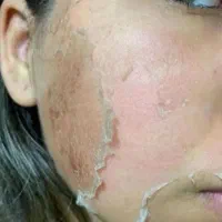 درمان لک های پوستی