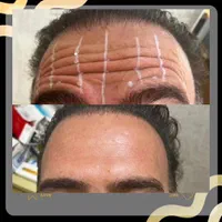 جشنواره تخفیفی بوتاکس
