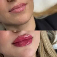 پزشک نخ لیفت مزو کلاژن آنزیم ژل بوتاکس فیلر prp|خدمات زیبایی و سلامت|کرج, گوهردشت|دیوار