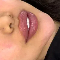 آموزش تزریق ژل بوتاکس کامپوزیت انزیم بایوفیلربادی