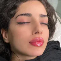 تزریق ژل وبوتاکس