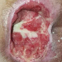 درمان تخصصی زخم و کارشناس زخم