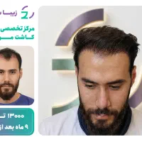 متد جدید میکروگرفت (کاشـت مـو) با تخفیف استثنایی