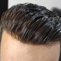 ترمیم مو و پروتز مو ( نیوفیس )