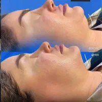 هایفو(لیفت صورت در یک جلسه)تخفیف ۵۰ درصدی|خدمات آرایشگری و زیبایی|مشهد, وکیل‌آباد|دیوار