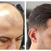 خدمات پروتز و ترمیم مو/پروتز دائم/پروتز مو|خدمات آرایشگری و زیبایی|اصفهان, وحید|دیوار