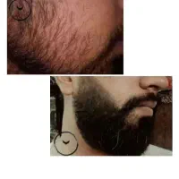 رویش ریش و سبیل به صورت کاملا تضمینی