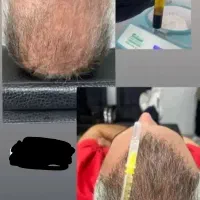 پی ار پی مو صورت فقط ۱۲۰۰