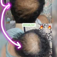 برای همیشه از دست ریزش موهات راحت شو