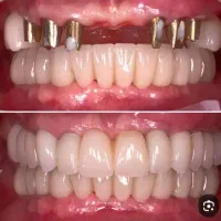 ایمپلنت کره ای فقط هفت میلیون و نهصد هزار