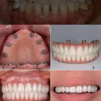 جشنواره دندانپزشکی ایمپلنت ۱۰/۳۰۰|خدمات آرایشگری و زیبایی|سلماس, |دیوار