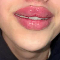 تزریق فیلر،ژل لب،فیلربینی|خدمات آرایشگری و زیبایی|شیراز, ریشمک|دیوار
