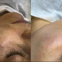 لیزرموهای زائد وپلاژن ترابی ویژه بانوان|خدمات آرایشگری و زیبایی|مشهد, توس (بلوار توس)|دیوار