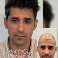 کاشت مو ابرو و ریش تارکوب