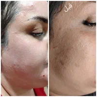 پاکسازی و جوانسازی پوست با آکوا فیشیال|خدمات آرایشگری و زیبایی|اردبیل, |دیوار