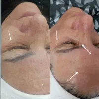 فیشال وپاکسازی تخصصی پوست