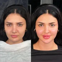 پایان جستجوکلینیک تخصصی پوست نخ ژل هایفو آموزش ژل|خدمات آرایشگری و زیبایی|تهران, زعفرانیه|دیوار