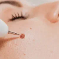 خدمات پلکسر از بین بردن خال وزیگیل|خدمات آرایشگری و زیبایی|پاکدشت, پاکدشت (مامازند)|دیوار