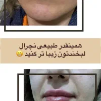 مطب زیبایی در کرمان با ضمانت صد در صد بوتاکس|خدمات آرایشگری و زیبایی|کرمان, |دیوار