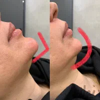 تزریق بوتاکس اصلی، ژل لب، خط خنده، زاویه فک وچانه|خدمات آرایشگری و زیبایی|ورامین, ورامین|دیوار