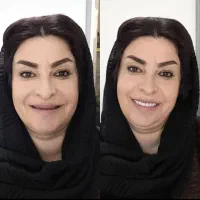 دندانپزشکی دندان مصنوعی  باطرح لمینیت جوان تر شوید