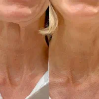 رفع چروک و خطوط گردن در کلینیک دکتر احیاکننده