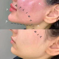 لیزر مو زائد وتتو فیلر ژل بوتاکسprp پاکسازی فیشیال|خدمات آرایشگری و زیبایی|اهواز, گلستان|دیوار