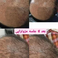 خدمات زیبایی بوتاکس ، ژل ،مزوتراپی، ریمو تتو هایفو|خدمات آرایشگری و زیبایی|فولادشهر, B2|دیوار
