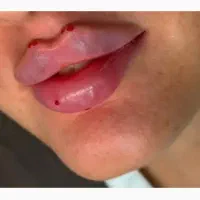 تزریق ژل وبوتاکس ژل لب گونه چانه زاویه خط لبخند