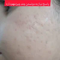 جای جوش و ابله و لک جوش|خدمات آرایشگری و زیبایی|دورود, |دیوار