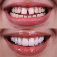 کامپوزیت نچرال/لبه شیشه ای/اقساط/خدمات رایگان