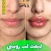 تزریق انواع بوتاکس ژل آنزیم بینی نخ جوانسازی|خدمات آرایشگری و زیبایی|صدرا-فارس, فاز ۱|دیوار