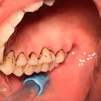 جرم گیری دندان با تعرفه دولتی تحت پوشش بیمه|آرایشی، بهداشتی، درمانی|اصفهان, دهنو|دیوار
