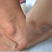 رفع تیرگی زانو آرنج قوزک پا