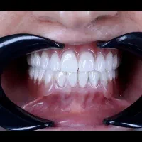 دست دندان طرح لمینیت