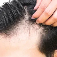 ریزش مو ارثی