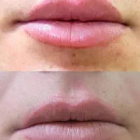 مدل فوری ریموو تتوی قدیمی وبدرنگ|خدمات آرایشگری و زیبایی|آمل, |دیوار