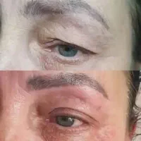 بلفاروپلاستی غیر جراحی با متد جدید فقط سه میلیون