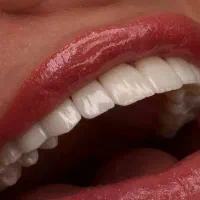 جشنواره ویژه کامپوزیت لمینت جرم گیری پالیش بلیچینگ