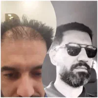 روش جدید بدون جراحی فول تراکم|خدمات آرایشگری و زیبایی|آمل, |دیوار