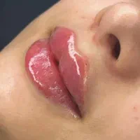 ژل و بوتاکس با تخفیف استثنایی