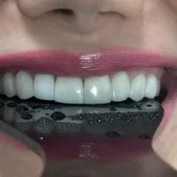 (زیبایی) ونییر کامپوزیت و لمینیت، بلیچینگ|خدمات آرایشگری و زیبایی|رشت, گلسار|دیوار