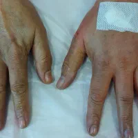 تزریق چربی تخلیه غبغب جراحی بلفاروپلاستی حفره بینی|خدمات آرایشگری و زیبایی|کرج, باغستان|دیوار