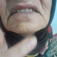 راهنمایی دندان مصنوعی