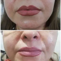 لیفت صورت و جوانسازی در یک جلسه|خدمات آرایشگری و زیبایی|شیراز, زند|دیوار